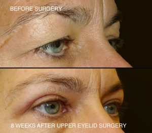 upper eyelid surgery uk